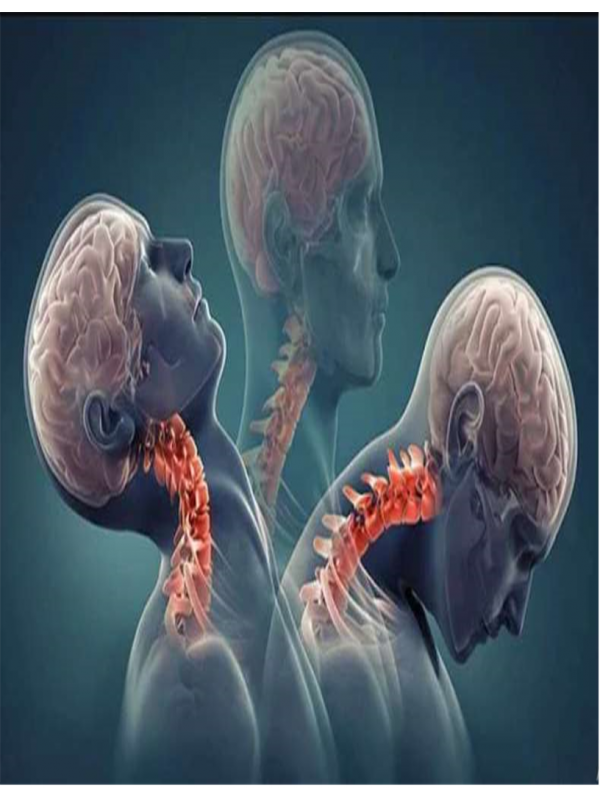 Whiplashed - Treating Symptoms